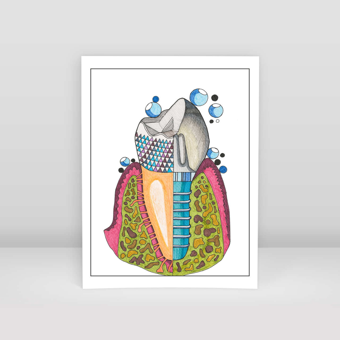 implant - Art Print