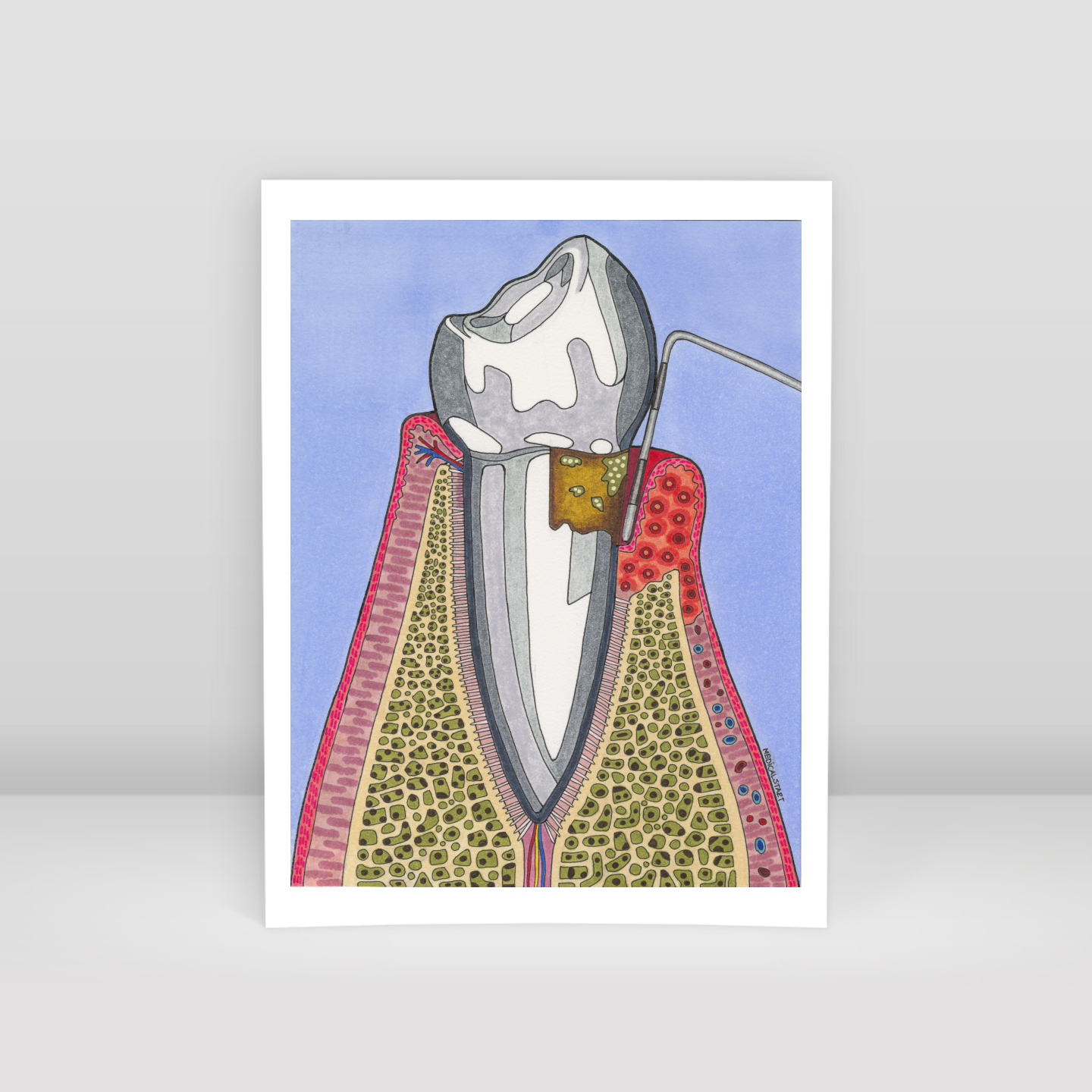 gingival recession - Art Print