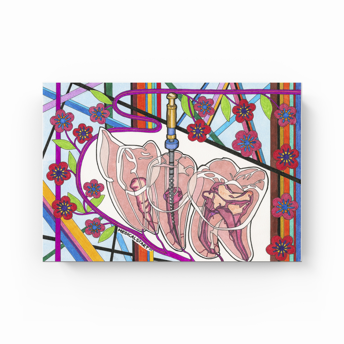 endodontics (canal treatment) - Kanvas Tablo