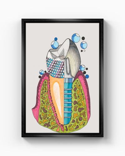 implant - Kanvas Tablo