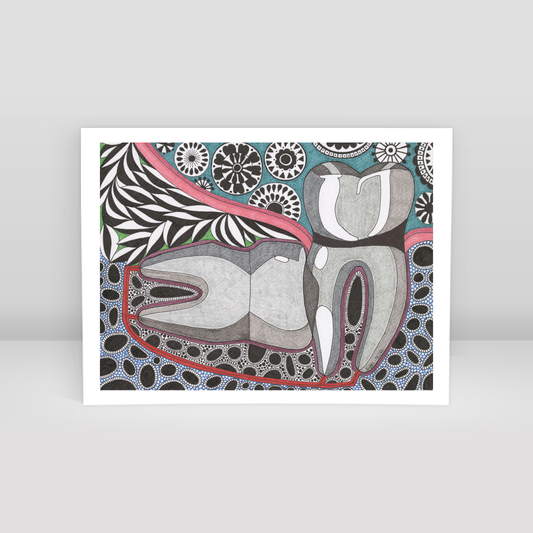 horizontal impact wisdom tooth - Art Print