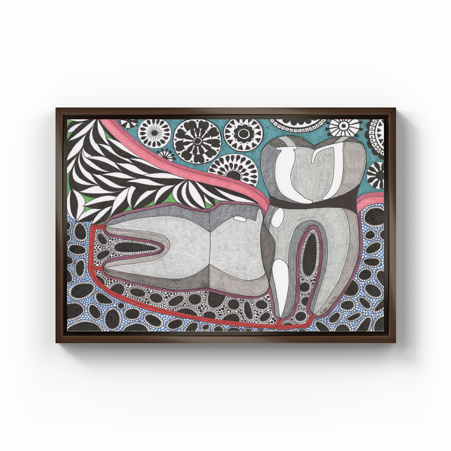 horizontal impaction wisdom tooth - Kanvas Tablo
