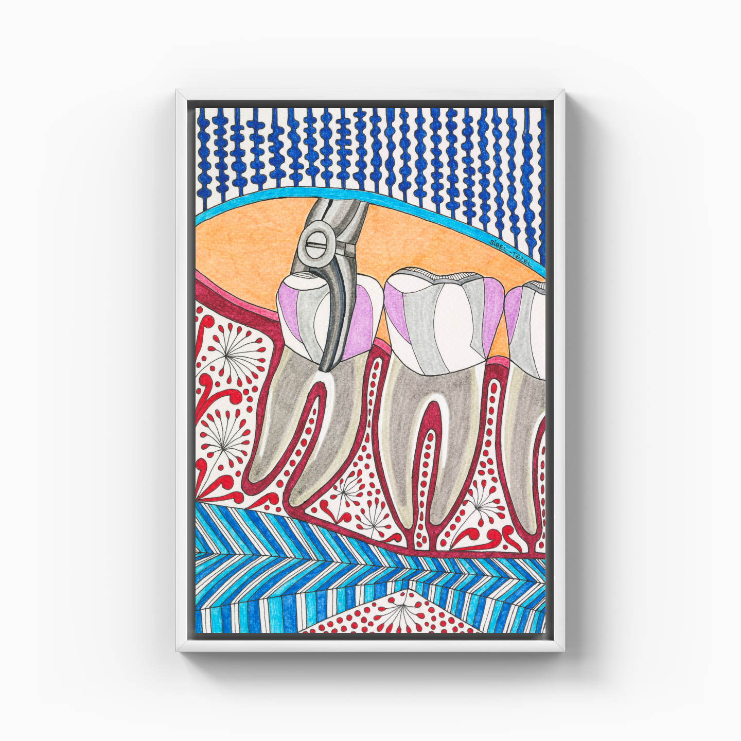 tooth extraction - Canvas Print