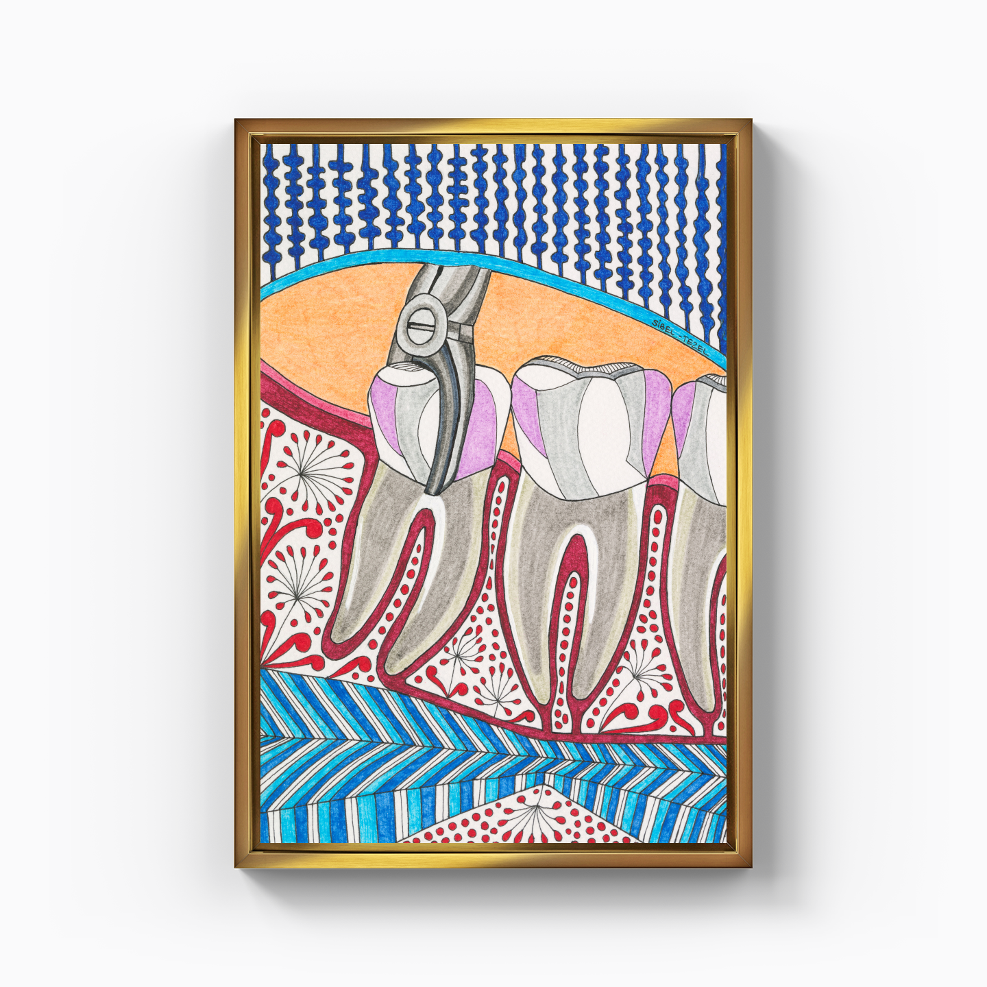 tooth extraction - Canvas Print