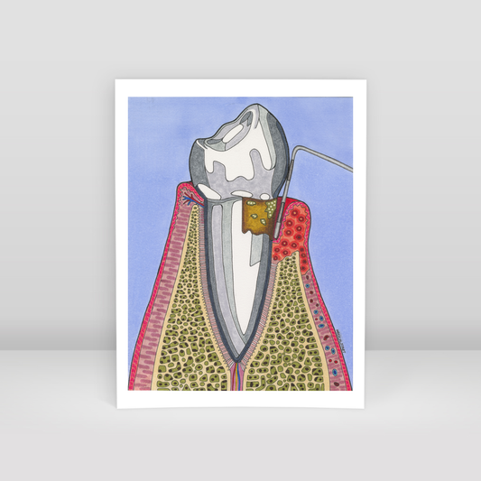 gingival recession - Art Print
