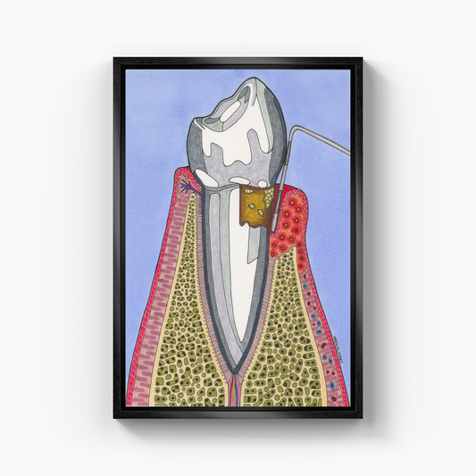gingival recession - Canvas Print