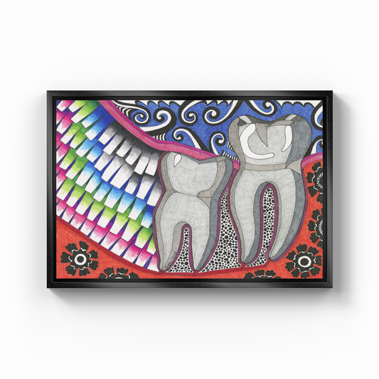 mesial impact wisdom tooth - Canvas Print