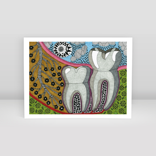 vertical impaction wisdom tooth - Art Print