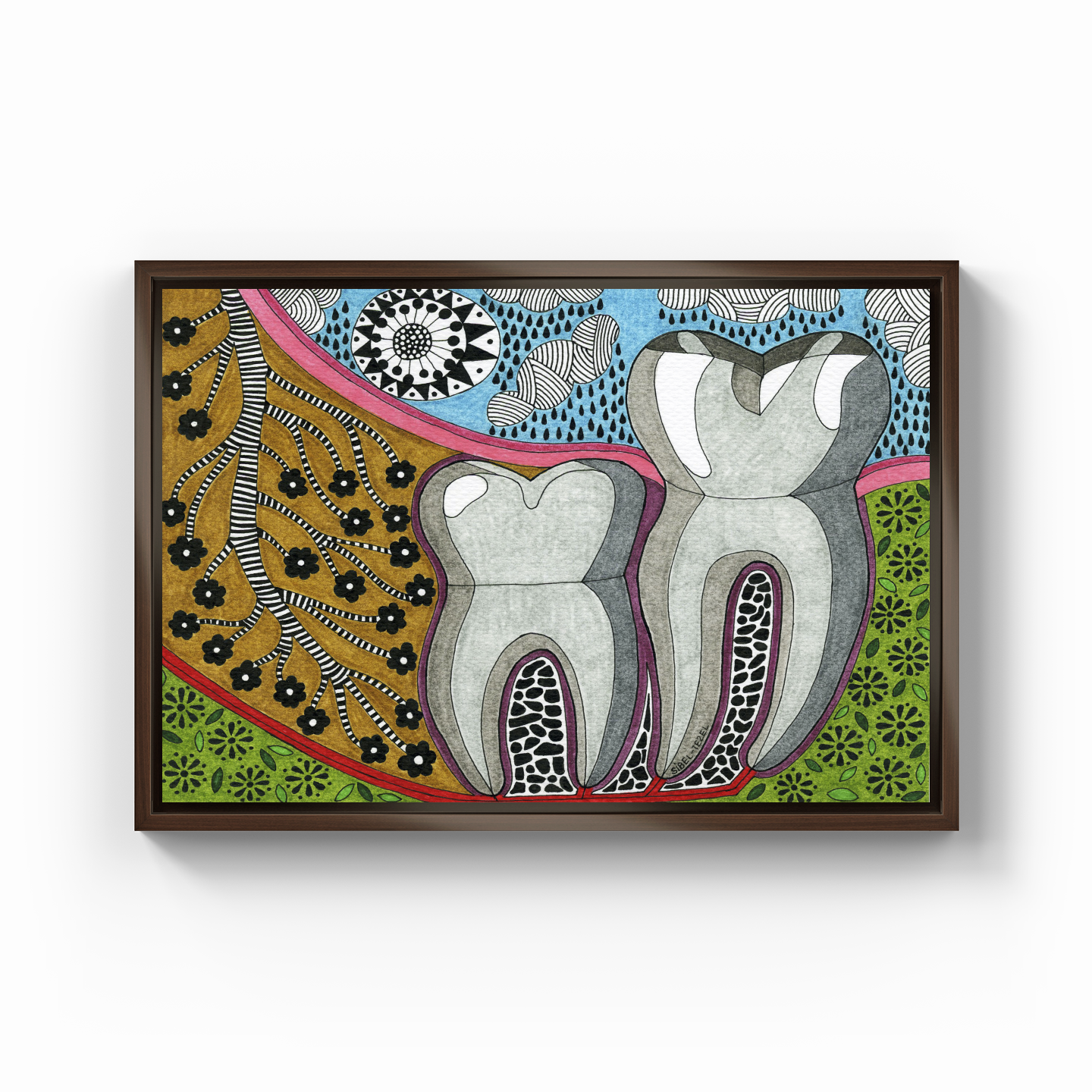 vertical impaction wisdom tooth - Kanvas Tablo