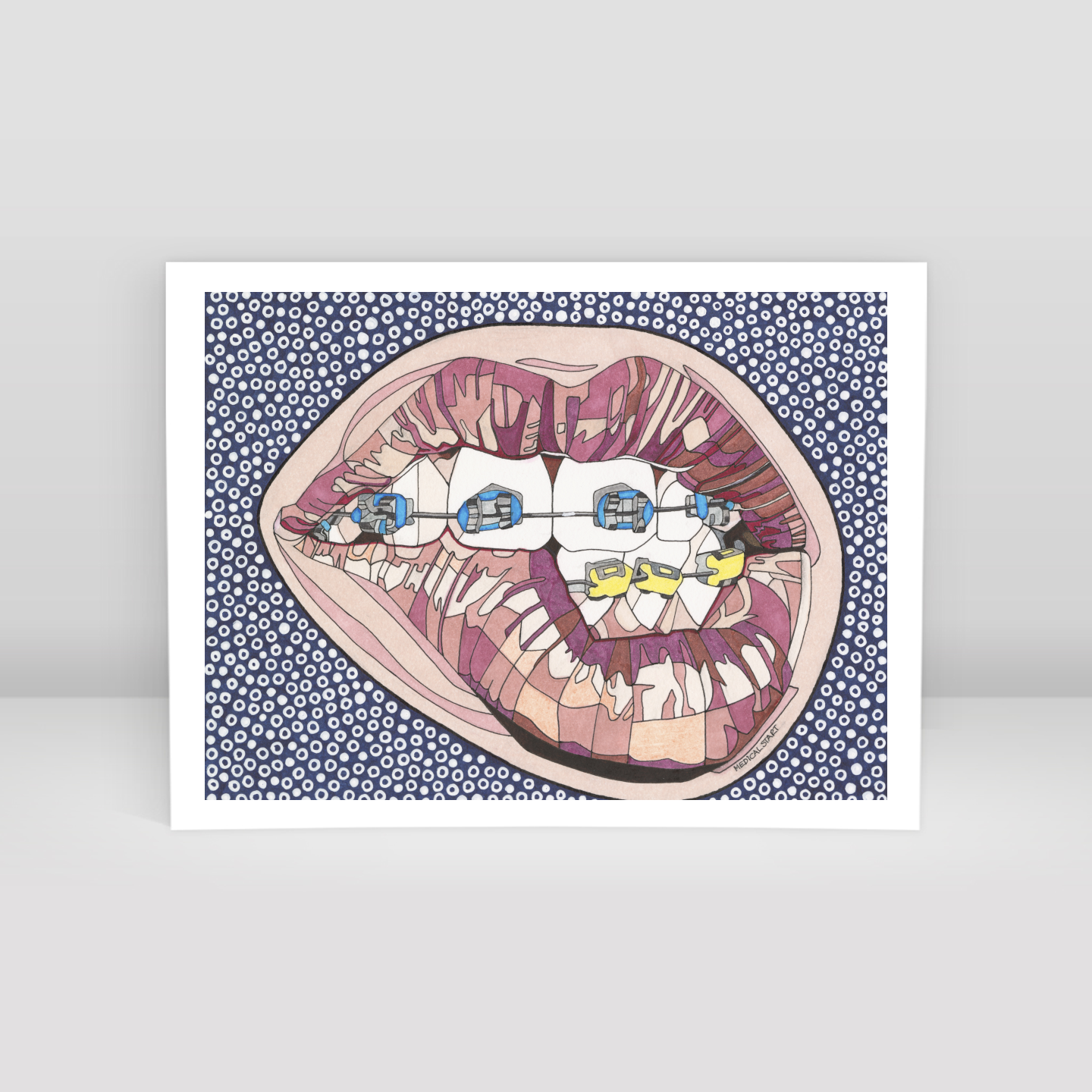 dental braces - Art Print