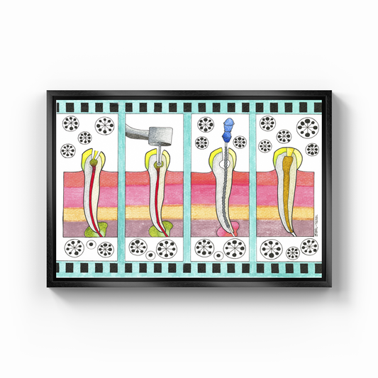 canal treatment - Canvas Print