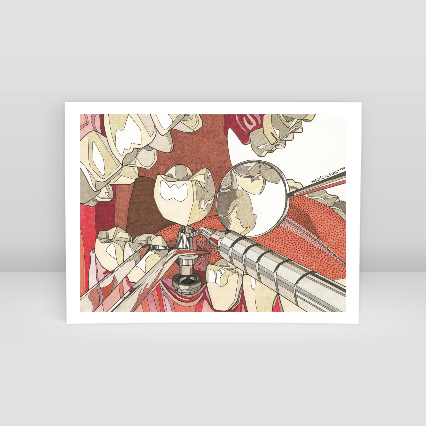 implant supported fixed partial denture - Art Print