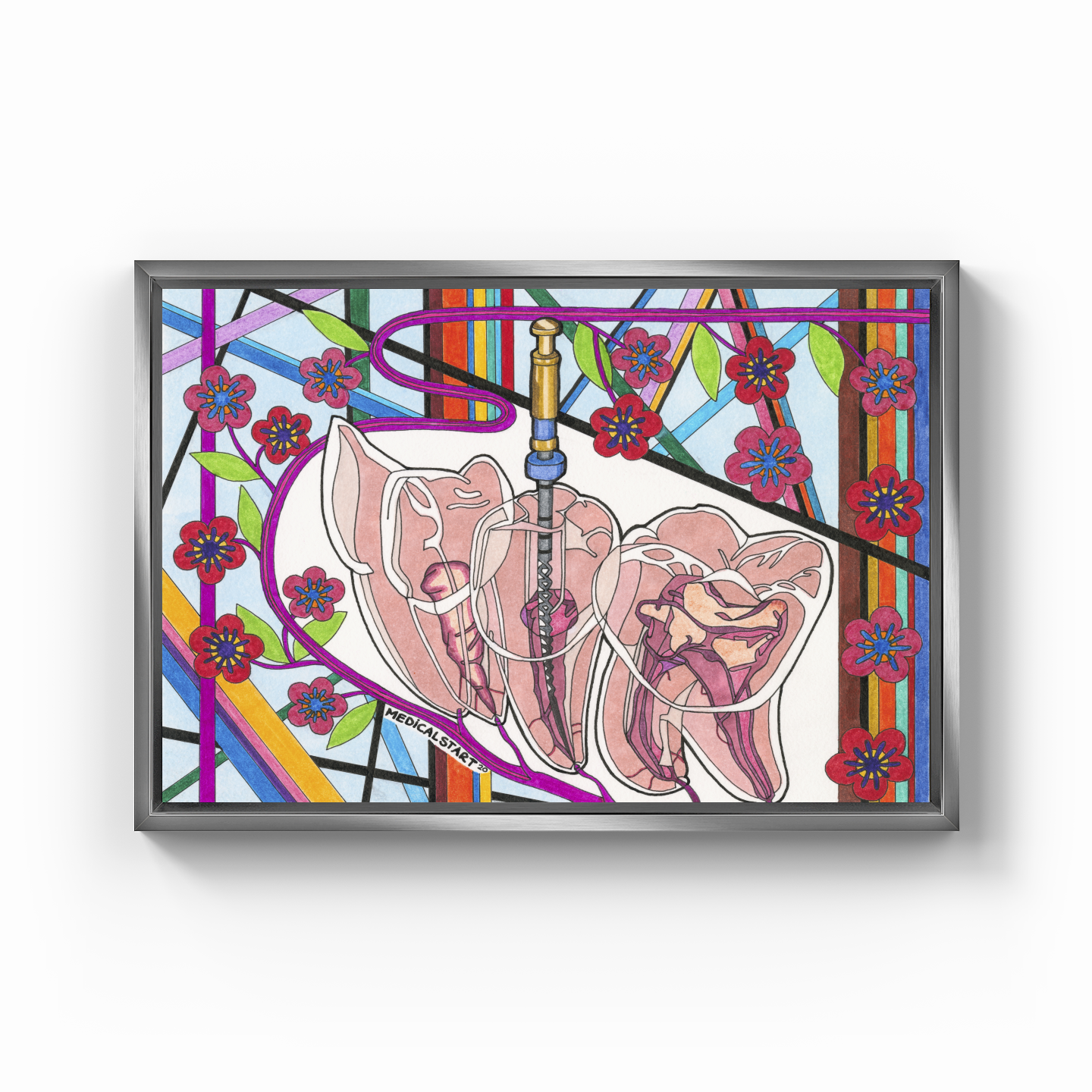 endodontics (canal treatment) - Kanvas Tablo