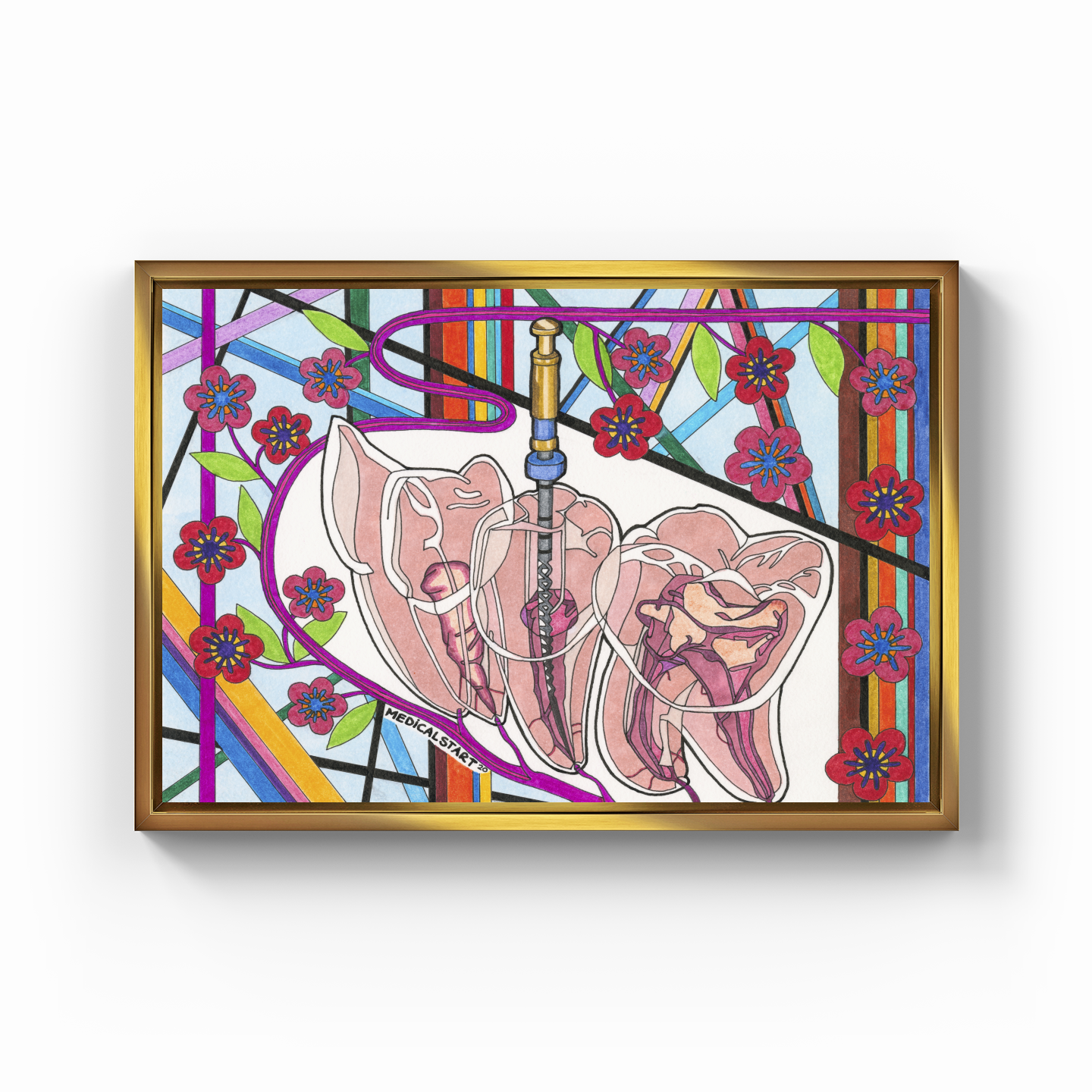 endodontics (canal treatment) - Kanvas Tablo