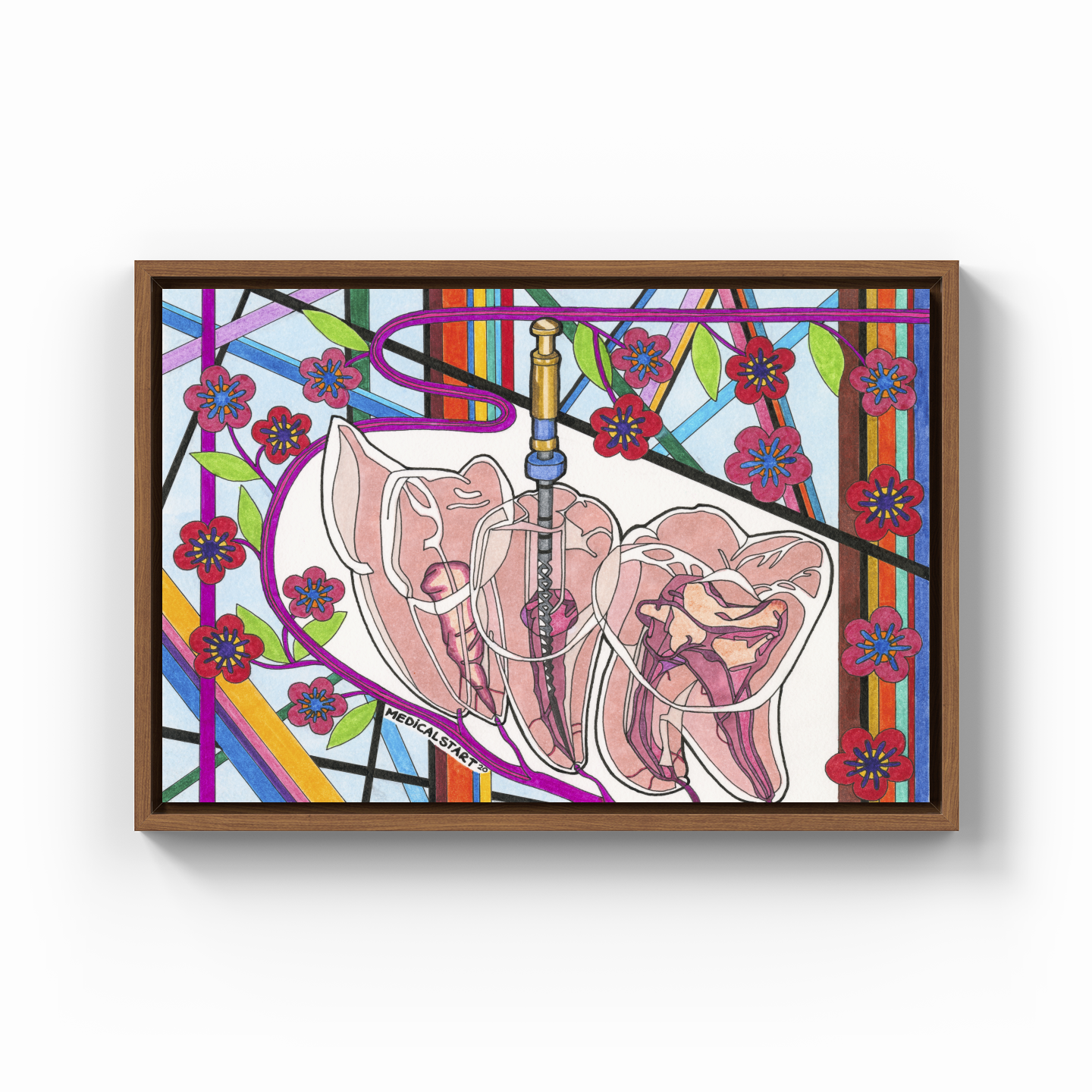 endodontics (canal treatment) - Kanvas Tablo