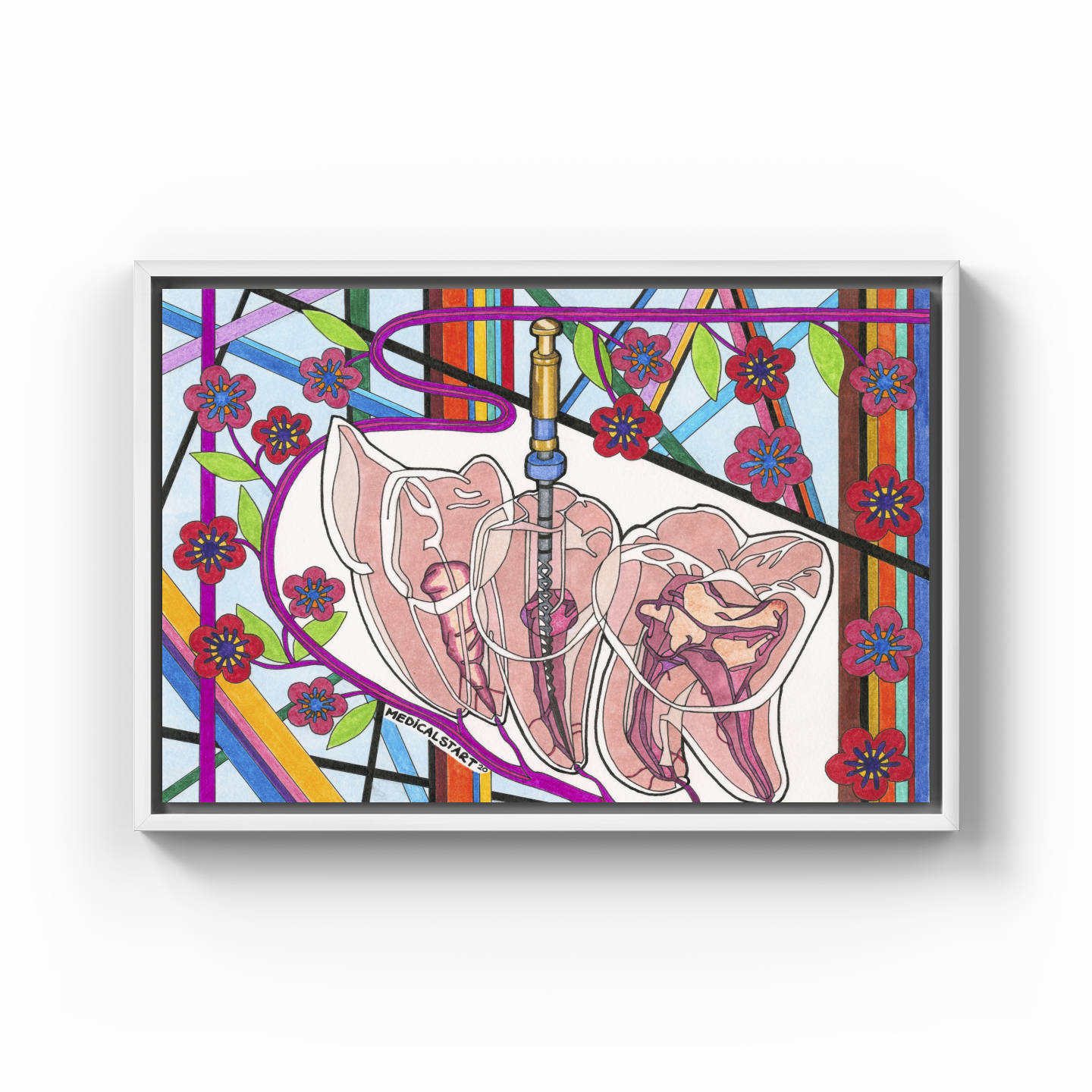 endodontics (canal treatment) - Kanvas Tablo